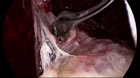 The pleural fluid may loculate between the visceral and parietal pleura (when there is partial fusion of the pleural. VATS for Loculated Pleural Effusion - Dr. Amol Bhanushali ...