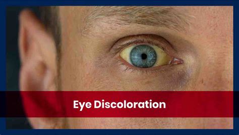 Causes And Types Of Eye Discoloration In The Whites Of The Eyes