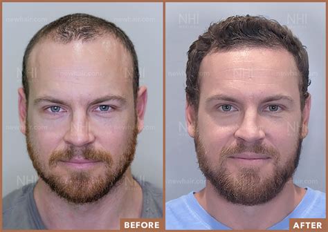 Before And After Hair Transplants For Men