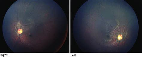 Fundus Examination By Ophthalmoscope Showing Bilateral Optic Papilla Is