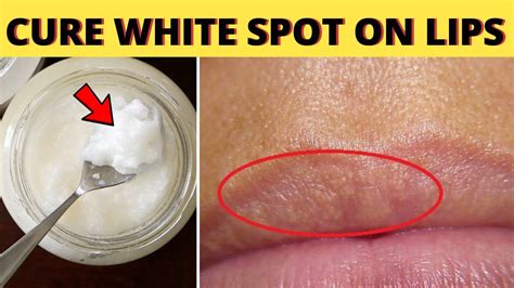 this remedy will naturally cure white spots on lips fast and effectively youtube