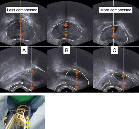 Robotic Transrectal Ultrasonography During Robot Assisted Radical