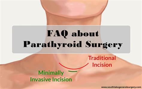 Faqs About Parathyroid Surgery By Southlake General Surgery On Dribbble