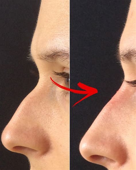 Non Surgical Nose Job V Rhinoplasty Before After Transformation
