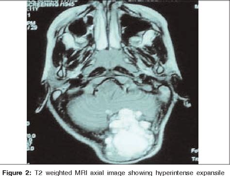 Figure 2 From Aneurysmal Bone Cyst Of The Occipital Bone Semantic