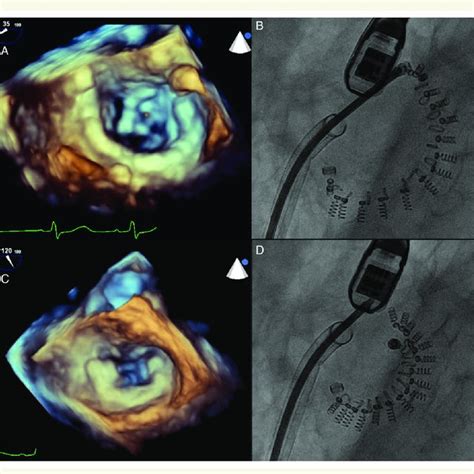 Pdf Cardioband A Transcatheter Surgical Like Direct Mitral Valve