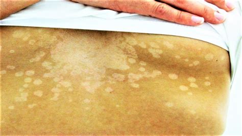 Tinea Versicolor Diagnosis And Treatment Treating Fungus On The Skin