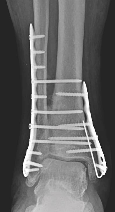 Keys To Treating Acute Ankle Fractures In Patients With Diabetes