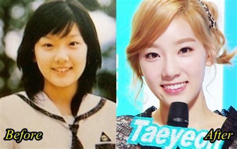 Snsd Before And After Plastic Surgery