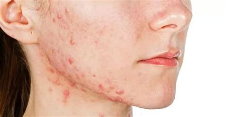 Depressed Acne Scars ⋅ Acne Scars Ai Beauty Clinic