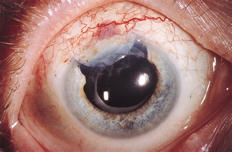 Adenoma Of The Nonpigmented Ciliary Epithelium Mimicking A Malignant
