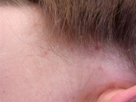 Mosquito Bites On Forehead