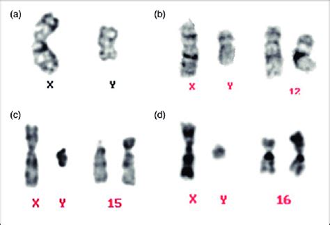 Karyotype Of Structurally Abnormal Chromosomes A Invy B Ty 12