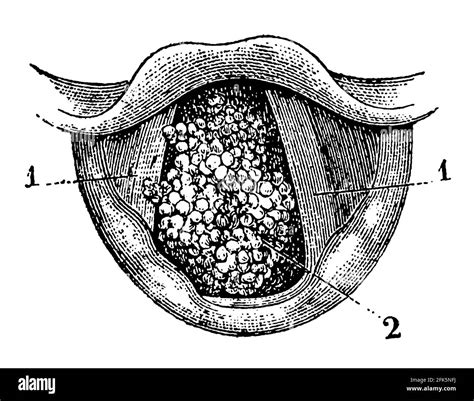 Bottom Bellied On The Larynx Vocal Cords And Villi Polyp Illustration