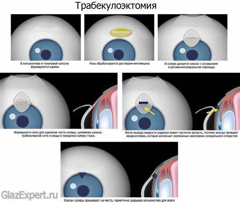 Диета при открытоугольной глаукоме