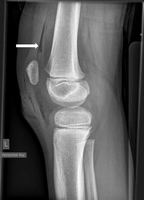 Figure Lateral Radiograph Of Knee Showing Gas In The Suprapatellar