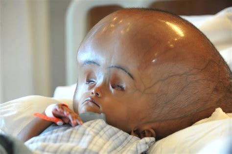 Toddler Roona Begum Who Nearly Died When Her Head Swelled To Twice Its