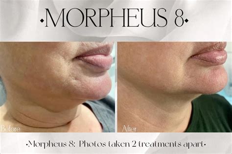 Morpheus 8 Before And After La Beauty Skin Center