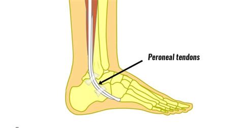 Peroneal Tendon Dislocation Symptoms Causes Treatment Rehab