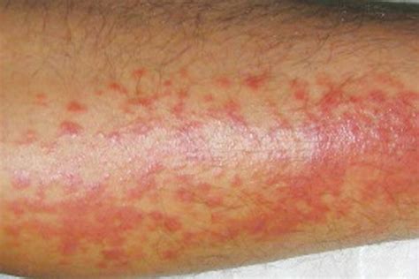 Derm Dx Nonhealing Pruritic Rash After Vacation A 28 Year Old Man