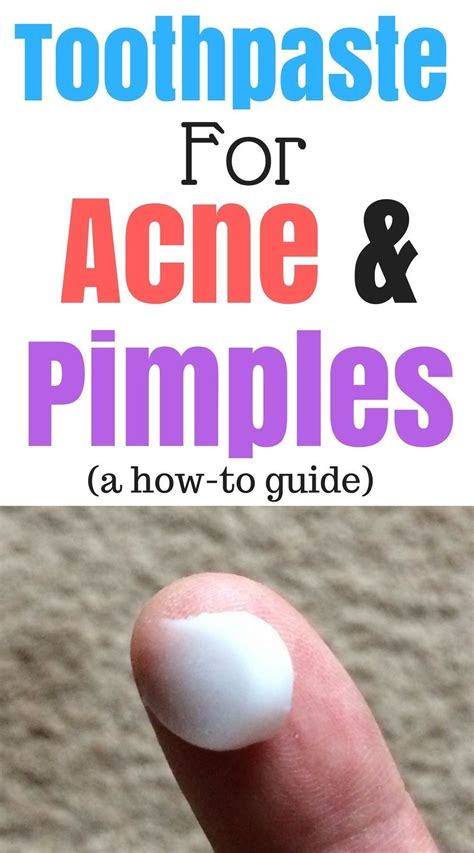 Toothpaste For Pimples Is A Good Quick Fix To Get Rid Of Pimples Fast Toothpaste For Acne Works