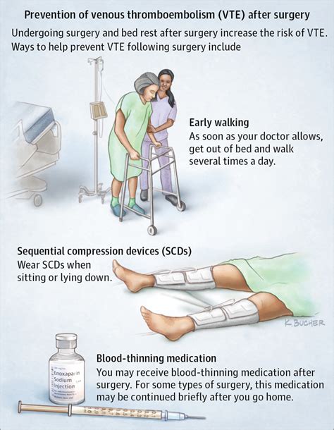 Preventing Venous Thromboembolism After Surgery Surgery Jama