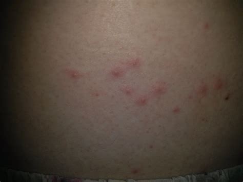 Small Red Bump On Skin Pictures Photos