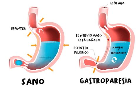 ¿qué Es La Gastroparesia