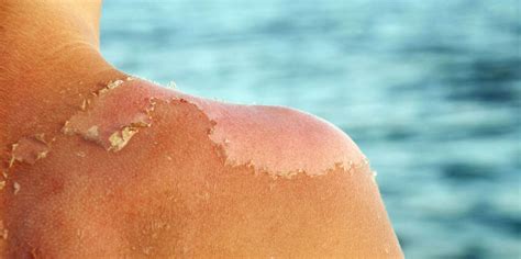 How Long A Sunburn Lasts Before Fading Away