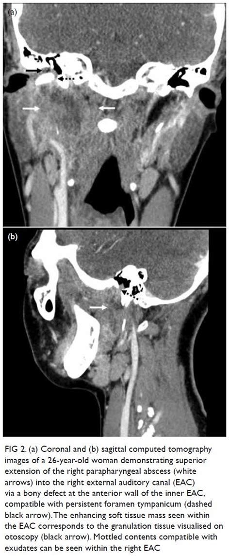 Parapharyngeal Abscess Presenting As Masticatory Otorrhoea Persistent