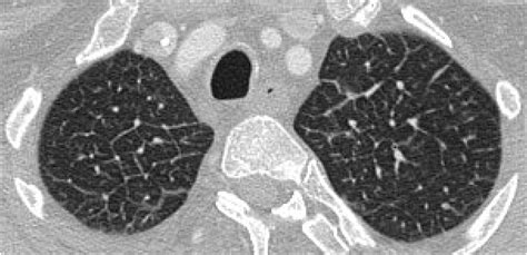 Pulmonary Edema A Pictorial Review Of Imaging Manifestations And