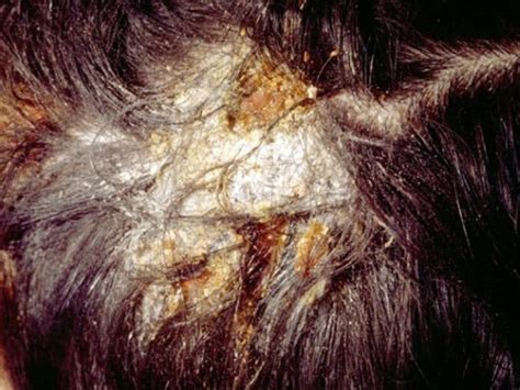 Scalp Yeast Infection Home Remedies Guide