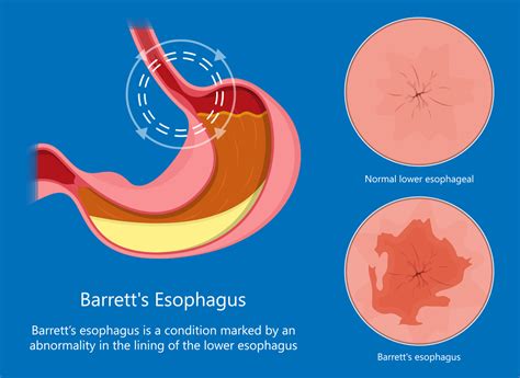 understanding barrett s esophagus gastrointestinal diseases inc columbus ga