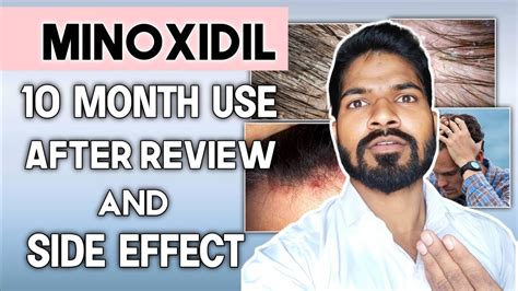 Minoxidil 10 Month After Review For Hair Regrowth And Side Effects Youtube