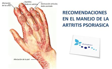 Recomendaciones en el manejo de la Artritis Psoriasica Clínica