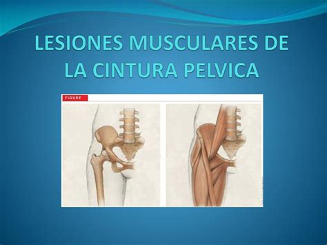 Ppt Lesiones Musculares De La Cintura Pelvica Powerpoint Presentation