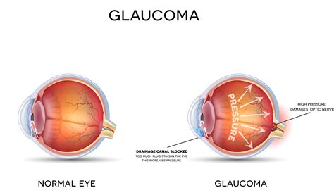Frequently Asked Questions About Glaucoma Part Clinica London