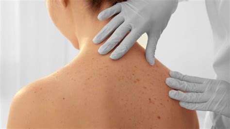 Traitement des tâches de peau | Clinique Médico Esthétique ...
