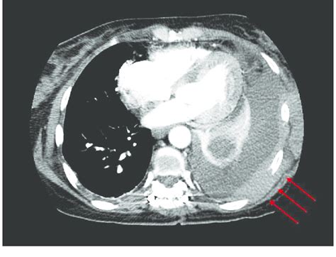 Ct Chest Showing Large Pleural Effusion With Collapsed Lobe Of The
