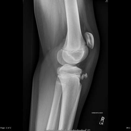 Tibial Tuberosity Avulsion Fracture Radiology Reference Article