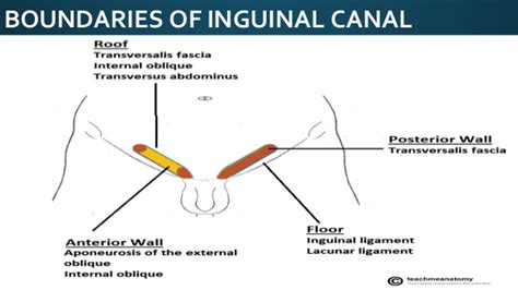 The hernia sac passes outside the boundaries of hesselbach's triangle(inguinal triangle) and follows the course of the spermatic cord. ANATOMY OF INGUINO-SCROTAL REGION
