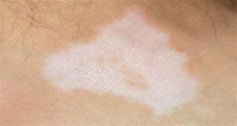 Beware Your Skin Rash Could Be Pointing To A Health Issue