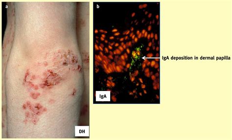 Autoimmune Blistering Skin Diseases Medicine