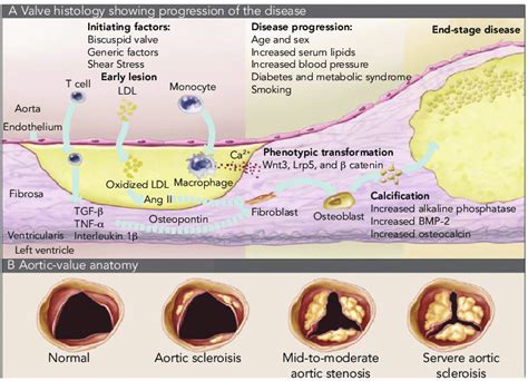 Schematic Illustration Of Pathophysiology Of Calcific Aortic Stenosis