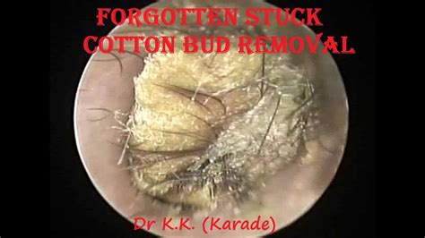 Oto Endoscopic Removal Of Forgotten Stuck Cotton Bud Mixed With Earwax