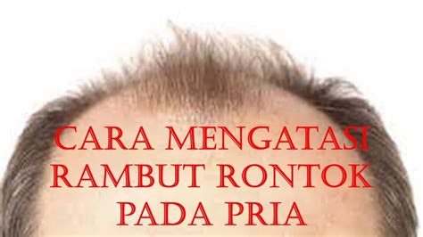 Cara Mengatasi Rambut Rontok Pada Pria Youtube