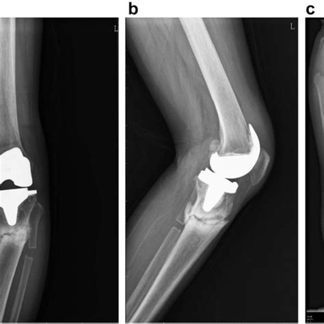 Radiographs Taken After Total Knee Arthroplasty A Anteroposterior