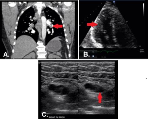 Southwest Journal Of Pulmonary Critical Care And Sleep Imaging Medical Image Of The Week