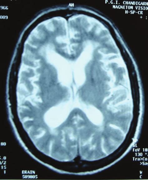 Mri Brain Axial T2 Image Shows Diffuse Cerebral Atrophy With Ex Vacuo