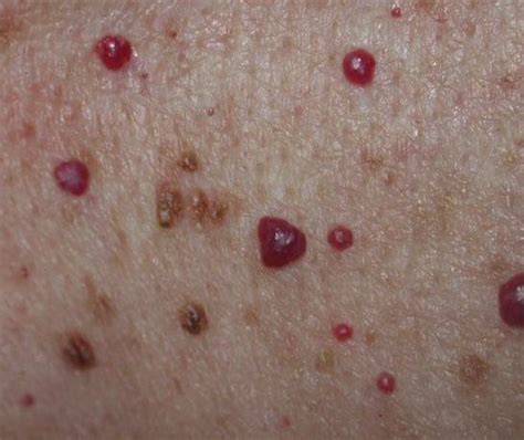 Cherry Angioma Red Skin Spots Skin Spots Cherry Angioma